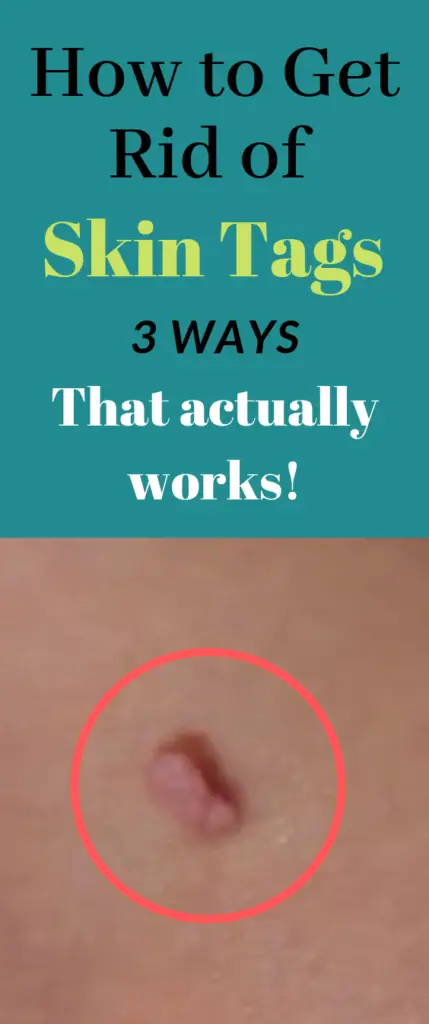 How to Get Rid of Skin Tags - 3 Ways That actually works
